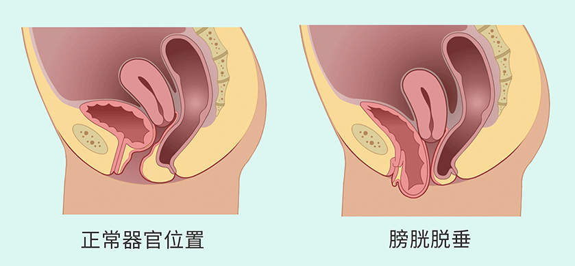 產后便秘8.png