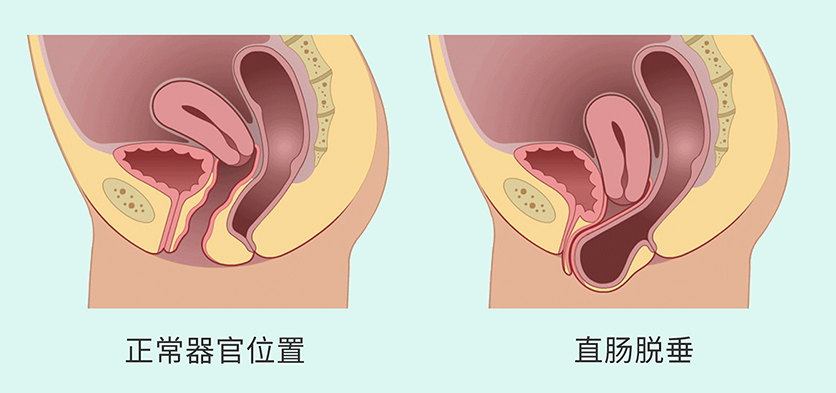 產后便秘3.png